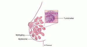 brostcancer_fordj2